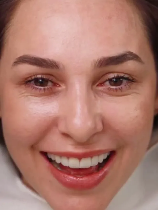 Alyssa – Hollywood Smile in Turkey Before and After