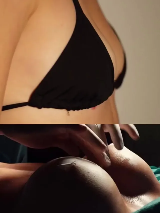 Ariel – Breast Augmentation in Turkey Before and After