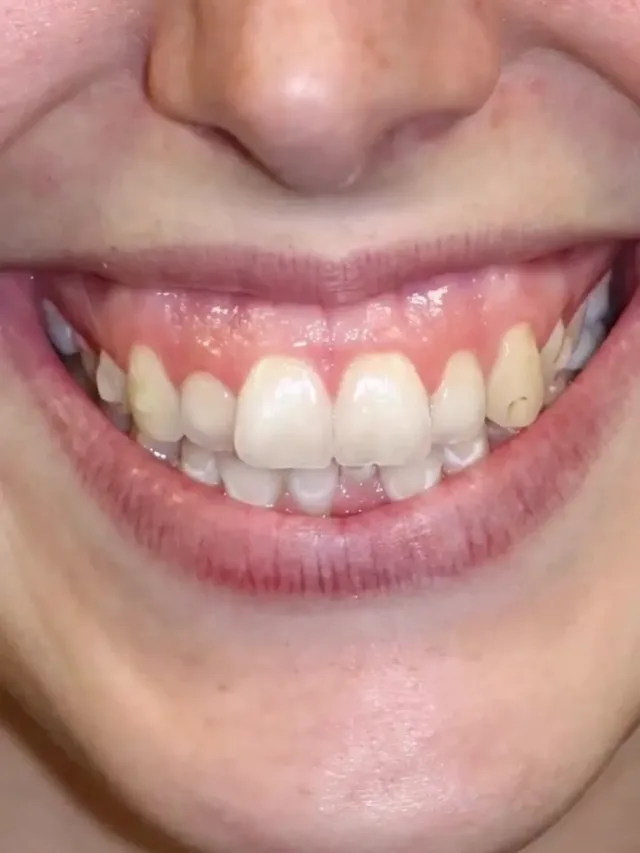 Cameron – Hollywood Smile Before and After