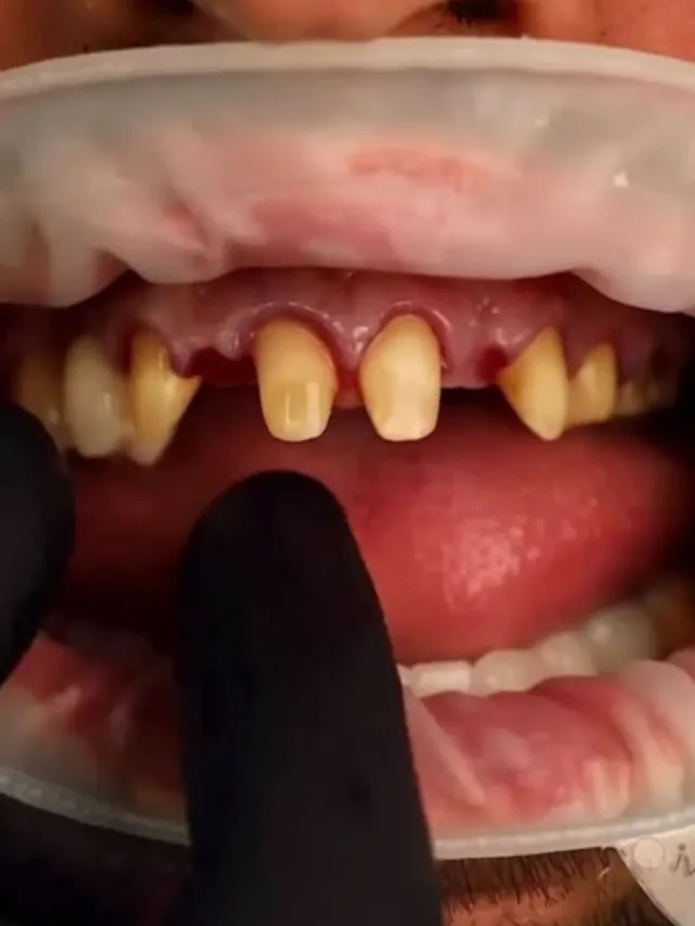 Christian – Hollywood Smile in Turkey Before and After
