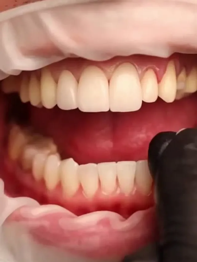 Colin – Hollywood Smile in Turkey Before and After