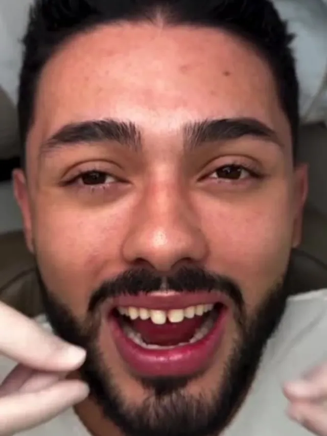 Darwin – Hollywood Smile in Turkey Before and After