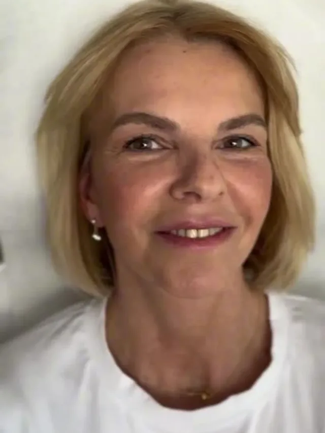 Fiona – Facelift Before and After