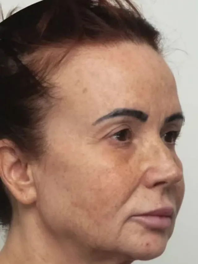 Francesca – Facelift Before and After