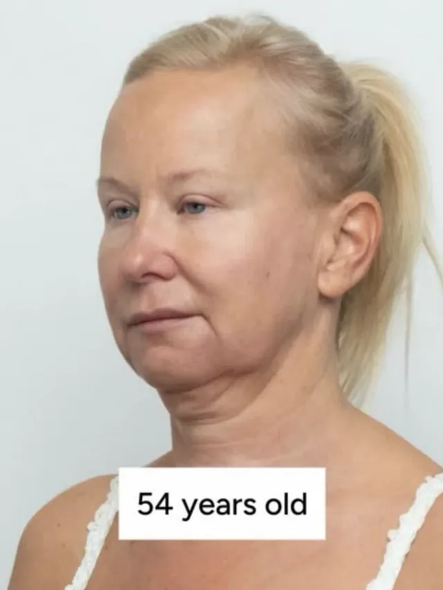 Isabel – Facelift Before and After