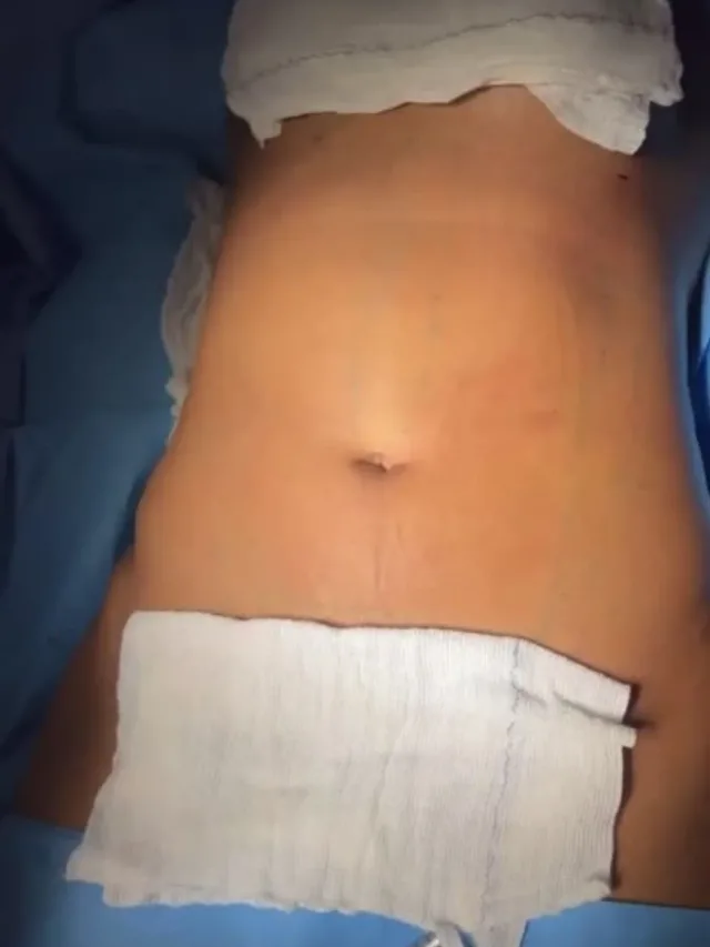 Janessa – Vaser 4D Liposuction Before and After