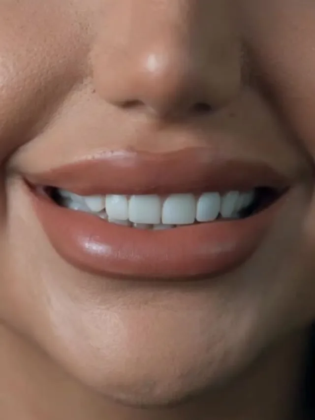 Jasmin – Laminate Veneers in Turkey Before and After