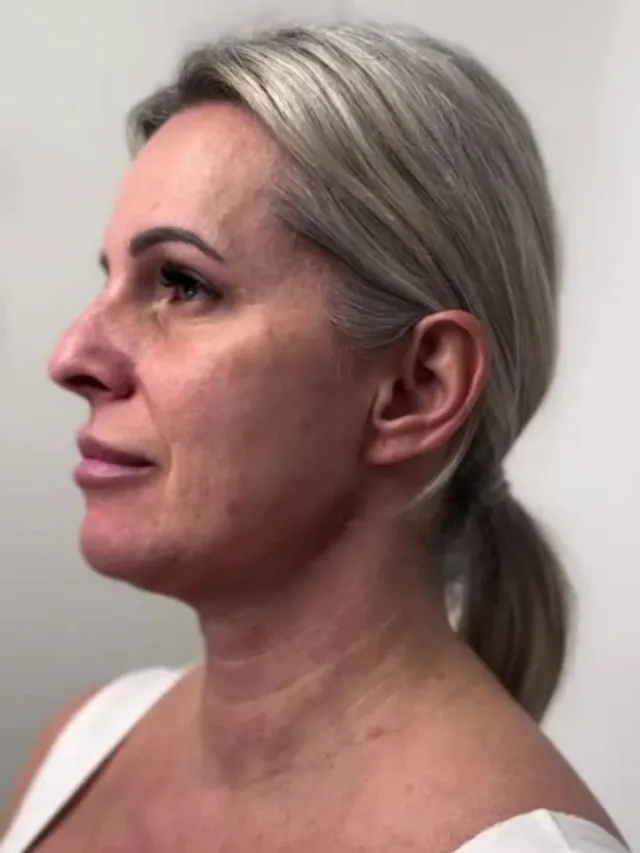 Jayde – Facelift Before and After