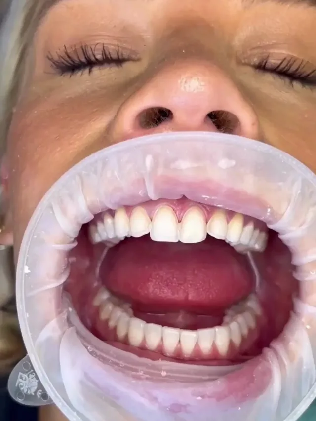 Julissa – Hollywood Smile in Turkey Before and After