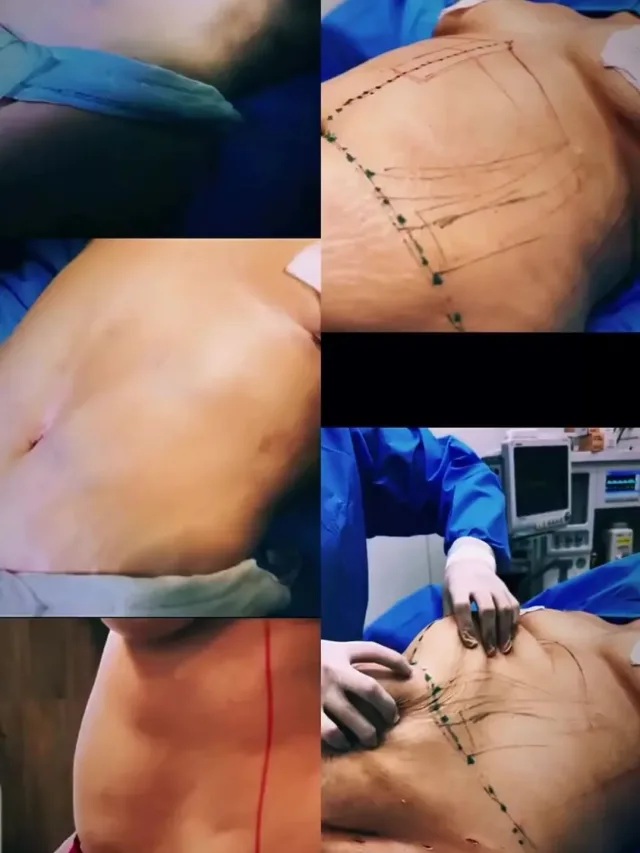 Kelli – Abdominoplasty in Turkey Before and After