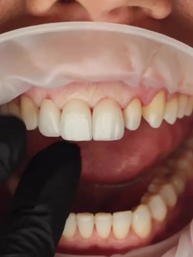 Kenzie – Hollywood Smile in Turkey Before and After