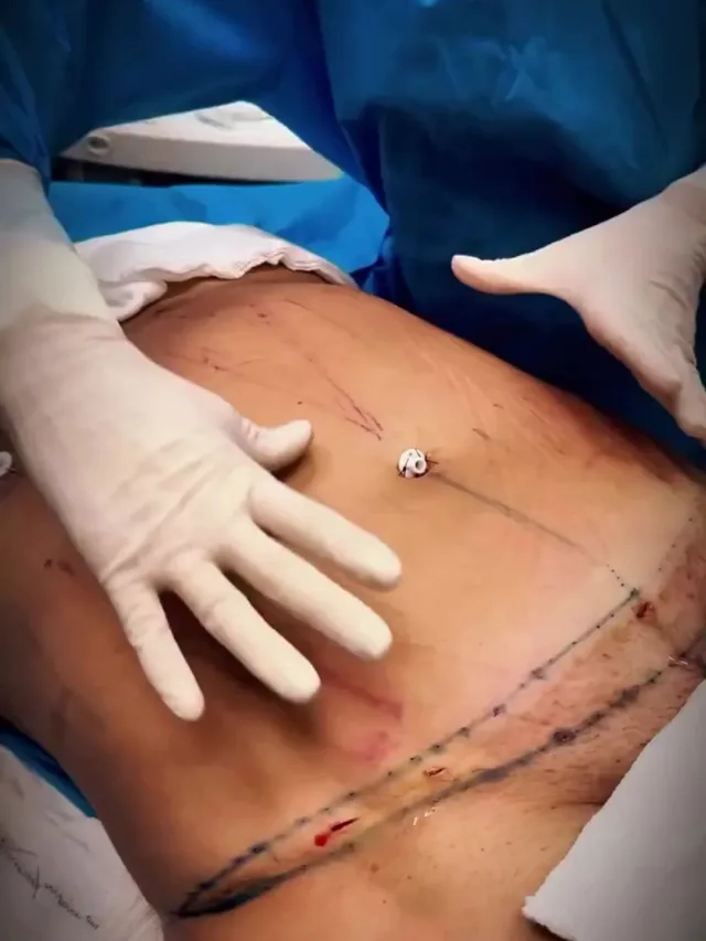 Laila – Vaser 4D Liposuction in Turkey Before and After