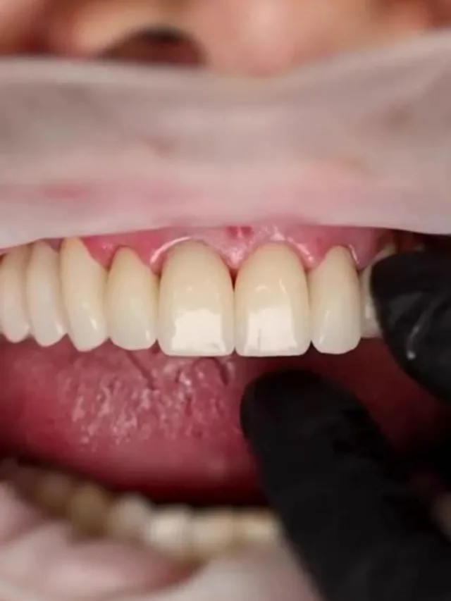 Lauryn – Hollywood Smile in Turkey Before and After