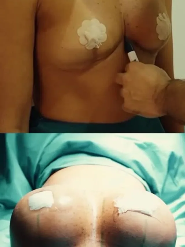 Leilani – Breast Augmentation in Turkey Before and After