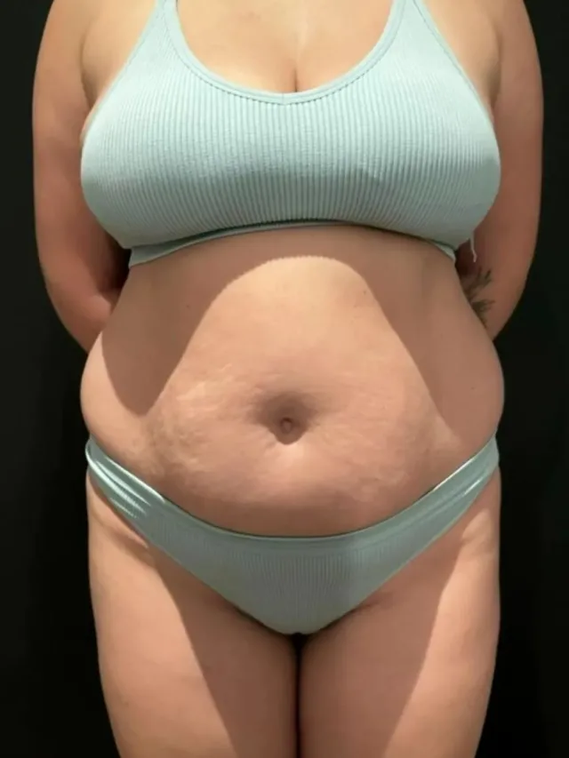 Lesley – Tummy Tuck in Turkey Before and After