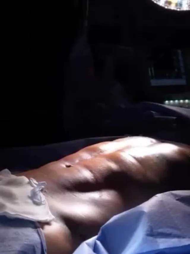 Ricardo – Six Pack Surgery in Turkey Before and After