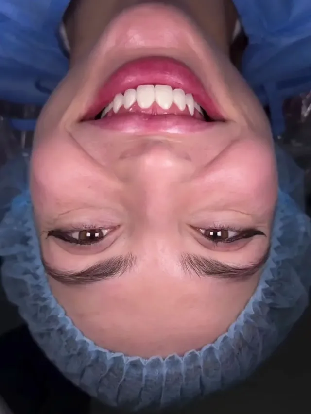 Roxana – Hollywood Smile in Turkey Before and After