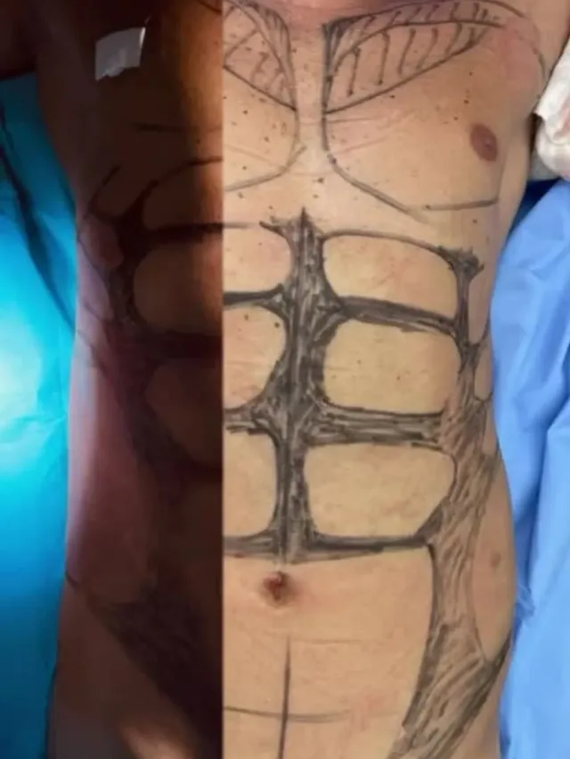 Scott – Six Pack Surgery in Turkey Before and After