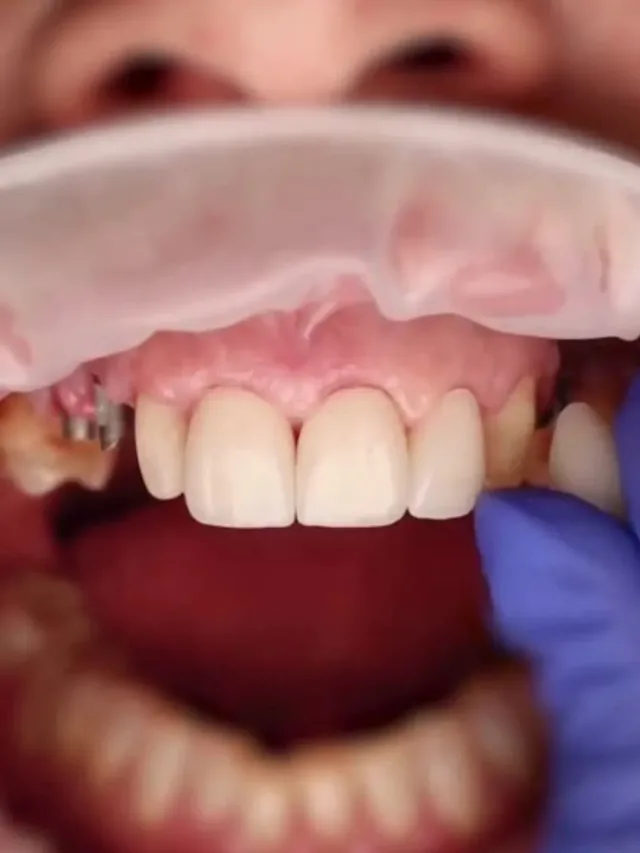 Yvette – Hollywood Smile in Turkey Before and After