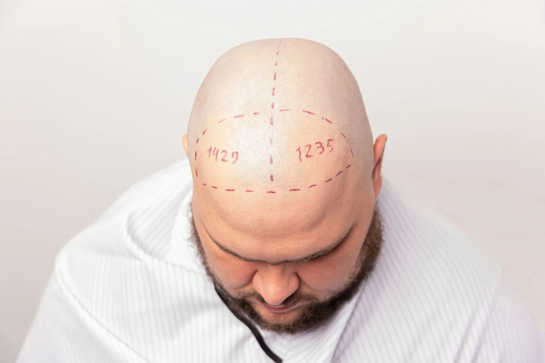 Ice FUE Hair Transplant in Turkey 1 Ice FUE Hair Transplant in Turkey